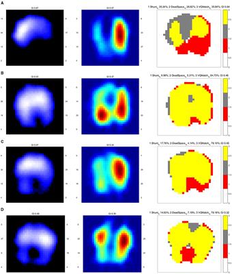 The Role of Electrical Impedance Tomography for Management of High-Risk Pulmonary Embolism in a Postoperative Patient